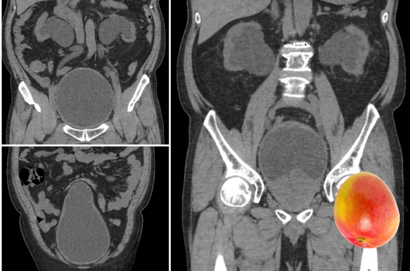 該患者前列腺肥大，腫大如芒果